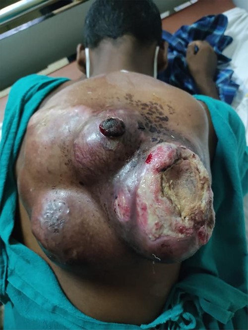 At the time of presentation. The picture shows a mass in the left upper back of size 20 × 20 cm2 with overlying ulceration and minimal discharge at the time of presentation.