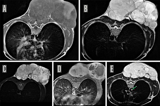 MRI chest. MRI of the chest on axial sections reveal a large well defined lobulated soft-tissue mass in the subcutaneous plane of the posterior chest wall, predominantly iso-hypointense on T1WI (A) with few areas of T1 hyperintensity and hyperintense on T2W image (B) and STIR images (C) and showing heterogenous enhancement with few central non-enhancing areas of necrosis on post contrast T1W images (D). Multiple internal septations were noted within the lesion with significant external contour bulge abutting the posterior chest wall muscles as well as bilateral posterior paraspinal muscles suggestive of a neoplastic process, possibly a mesenchymal tumor. MRI chest also shows a suspicious nodule (8 mm maximum diameter) appearing hyperintense on T2W image in the azygous lobe of right lung (indicated by green arrow) (E).