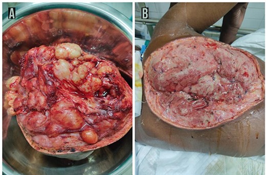 Post-operative findings. Post-operative picture of the excised part of the tumor showing 15 × 11 cm2 lobulated mass containing solid and cystic component with areas of necrosis and necrotic fluid with encapsulated well vascularized adhering to the surrounding structure extending deep up to ligamentum flavum but no encasing it (A). Post-operative picture of the posterior thorax showing the tumor base after wide en-block excision of the tumor (B).