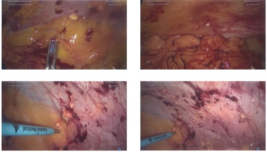 Intra-operative photographs of peritoneal nodules.