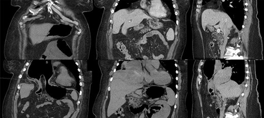 Top row: prior admission imaging. Top left: anterior coronal image showing immediate retrosternal diaphragmatic defect. Top middle: posterior coronal image showing liver abutting diaphragmatic defect. Top right: sagittal image showing liver covering diaphragmatic defect. Bottom row: imaging at time of acute incarceration. Bottom left: anterior coronal image showing incarcerated gastric antrum. Bottom middle: posterior coronal image showing incarcerated left hepatic lobe. Bottom right: sagittal right paramedian cut showing incarcerated liver and stomach.