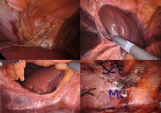 Top left: imaging from prior diagnostic laparoscopy, after lysis of the falciform ligament. Top right: image from re-presentation during reduction of left lobe of liver. Bottom left: patent foramen of Morgagni with no hernia sac showing right lung and pleural space. Bottom right: repair of hernia using 2-0 V-Loc, 0 Ti-Cron and Parietexmesh.