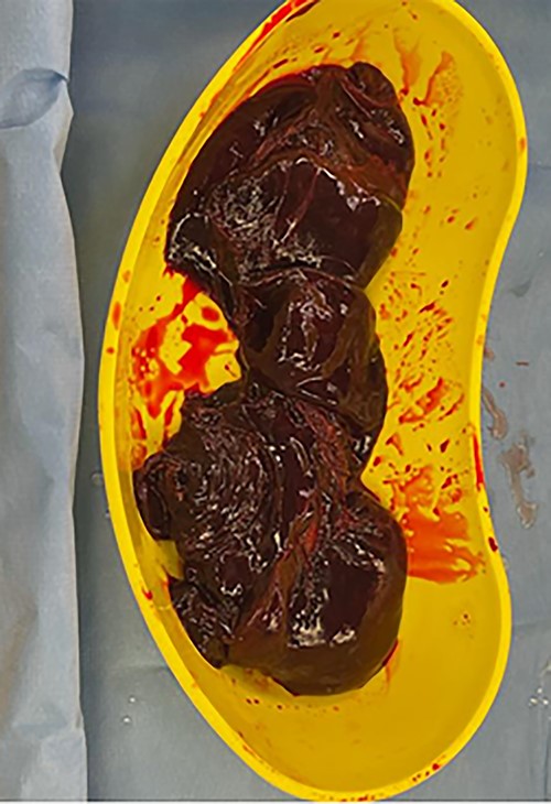 Retroperitoneal clot of 300 ml evacuated.