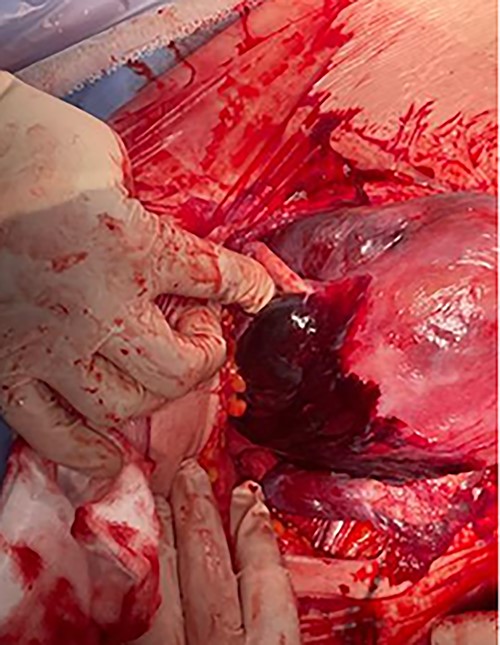 Couvelaire uterus.