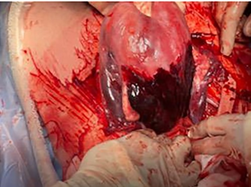 Bleeding from posterior wall of uterus.
