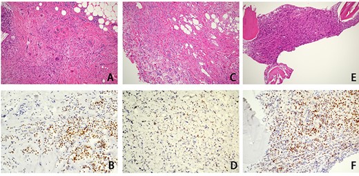 Histological examination findings for ILC of the breast. An hematoxylin–eosin examination of primary breast cancer that had been resected 9 years earlier showed ILC of the breast (A), and ILC was also shown in the biopsy specimens of the orbit (C) and bone marrow (E). Immunohistochemical studies showed positive ER expression in the primary breast cancer (B) and biopsy specimen of bone marrow (F), whereas the ER expression of the biopsy specimen of the orbit (D) was negative.
