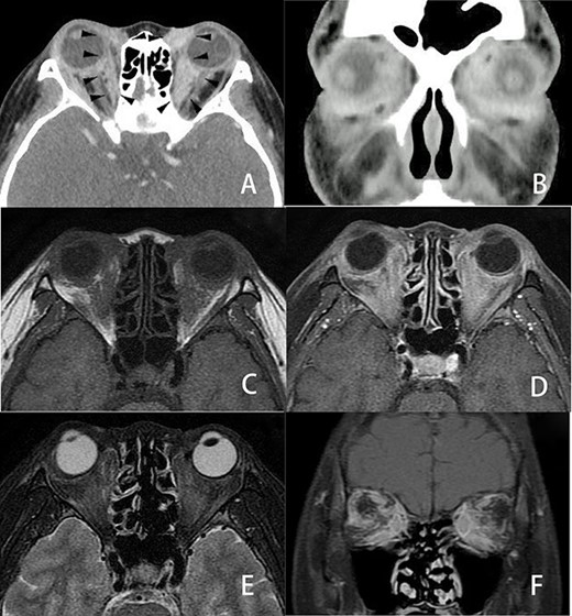 Three-dimensional imaging findings of orbital metastasis from breast cancer. Axial (A) and coronal (B) CT with contrast showed abnormal soft tissue enhancement (arrow) along the eyeball in the medial to retrobulbar portions of the bilateral orbits. The enhancement of the left orbit was greater than that of the right orbit. Axial MRI (C, D, E) also revealed an ill-defined tumor involving the soft tissues at the same portion where the soft tissue enhancement was seen on CT in the bilateral orbits. These orbital tumors were hypointense to fat tissue on axial T1-weighted imaging (C) and slightly enhanced on axial T1-weighted imaging with contrast (D) but slightly hyperintense to fat tissue on axial fat-suppressed T2-weighted imaging (E). Coronal fat-suppressed T1-weighted imaging with contrast (F) showed heterogenous irregular enhancement in the retrobulbar portion of the bilateral orbits. CT and MRI revealed no destruction of the eyeball, optic nerve or orbital bony wall.