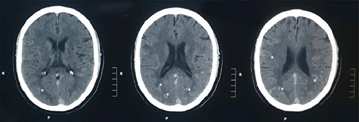 Plain CT head: plain CT head (axial sections) at the level of lateral ventricles show multiple linear areas of hyper-densities along cortical sulci of bilateral temporo-parieto-occipital lobes (shown by asterisks).