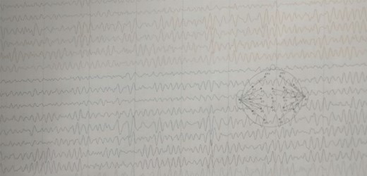 EEG: EEG showing interictal EEG record with intermittent slow wave in theta region with alpha activity on the background.