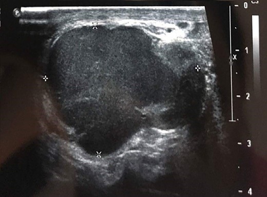 Testicular ultrasound showing a hypoechoic left extra testicular scrotal mass that is highly vascularized at Doppler.