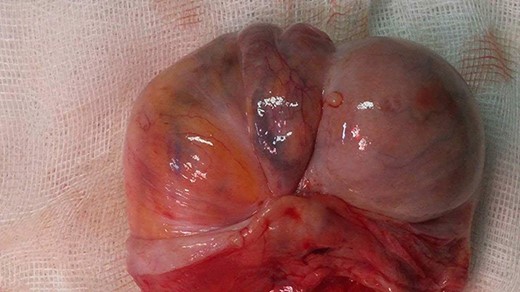 Left radical orchiectomy specimen containing a spermatic cord tumor.
