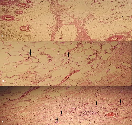 (a) HEX4: Lobules of adipocyte cells separated by fibrous septa. (b) HEX400: large nuclei, (c) HEX400: atypical cells: enlarged nuclei with irregular contours.