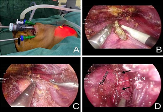 (A) Placement of a transcutaneous silk 2-0 holding suture on the midline to aid in initial dissection. (B) Division of the strap muscles along the median raphe using an L-hook cautery. (C) Retraction of the strap muscle cephalad and laterally with a transcutaneous silk 2-0 suture to expose the right thyroid lobe. (D) Right PGs (black arrow) and RLN identified after completely removing the thyroid gland.