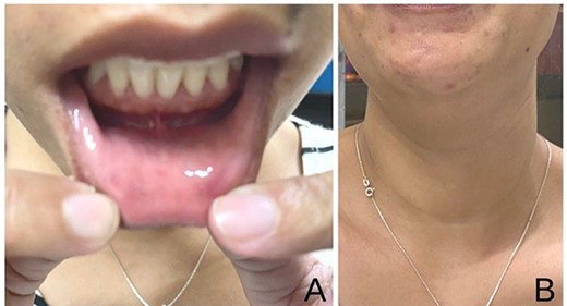 Follow-up at 6 months from surgery showing the patient’s (A) oral vestibule and (B) anterior neck totally free from ascar.