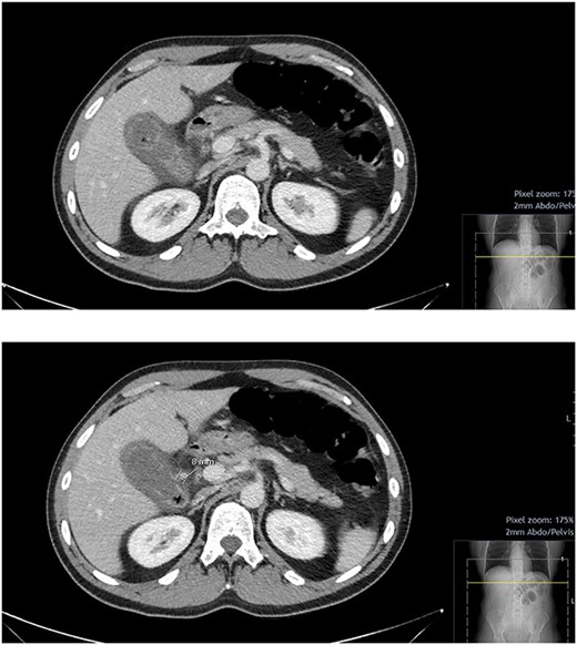 CT abdomen and pelvis with contrast; hyper-enhancing, oedematous gallbladder wall with fat stranding and gas locules consistent with acute calculous cholecystitis; suspected pseudoaneurysm of the cystic artery measuring 7.6 mm.