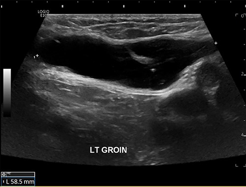 US scan of left groin showing a 59 × 25 × 13 mm anechoic thin-walled cystic structure in the canal of Nuck.