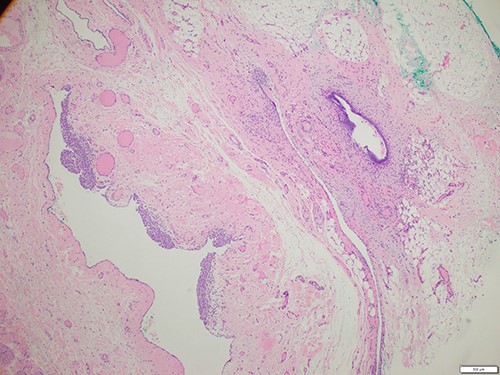 Histology of the surgical specimen (×40 magnification) shows a cystic structure lined in part by cuboidal epithelium in keeping with a cyst of canal of Nuck; focal endometriosis is identified in the adjacent soft tissue.