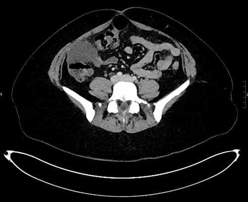 Axial CT demonstrating mass anterior to ascending colon with surrounding inflammatory changes.