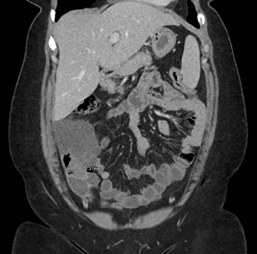 Coronal CT reconstruction measuring the largest dimension of mass.