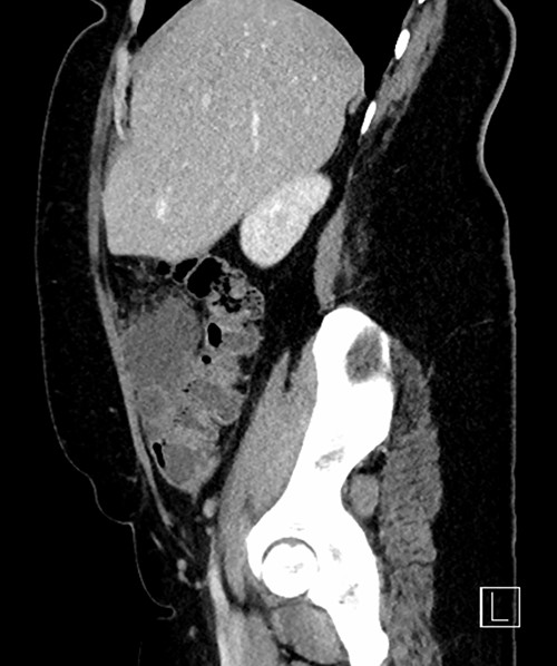 Sagittal CT reconstruction highlighting location of mass anterior to ascending colon.