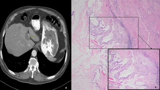 (A) Computed tomography (axial): ovoid low-density mass contiguous with dilated left hepatic bile duct. (B) Histology: invasive mucinous adenocarcinoma with an intraductal papillary mucinous component, in a background of high-grade dysplasia was identified involving the left hepatic lobe (segment 4b) and left hepatic duct.