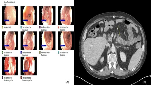 (A and B) Esophagogastroduodenoscopy (EGD) and computed tomography: lobular circumferential enhancing mass of the proximal fourth portion of the duodenum.