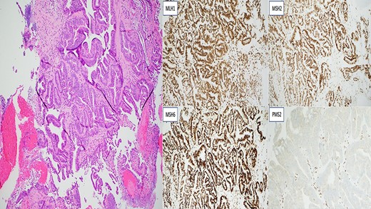 Invasive moderately differentiated adenocarcinoma with immunohistochemistry testing for mismatch repair proteins (MMR) significant for the loss of nuclear expression of PMS2 with retained strong expression of MSH2, MSH6 and MLH1.