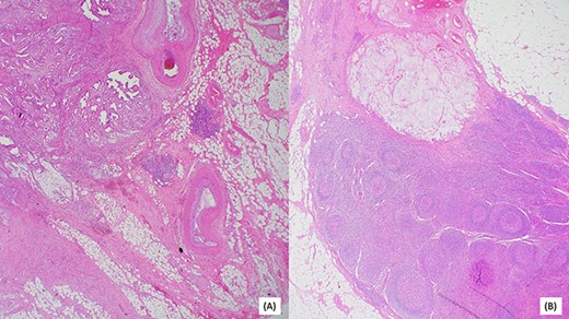(A) Invasive moderately differentiated adenocarcinoma with mucinous features invading the mesenteric fat of the small bowel. (B) One of 25 lymph nodes associated with acellular mucin.