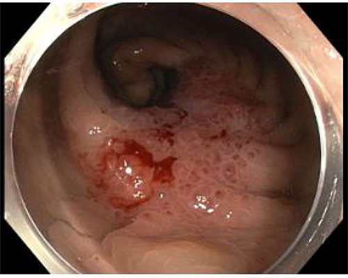Case A. Endoscopic image at time of initial diagnosis with rectal tumour, prior to neoadjuvant chemoradiation.