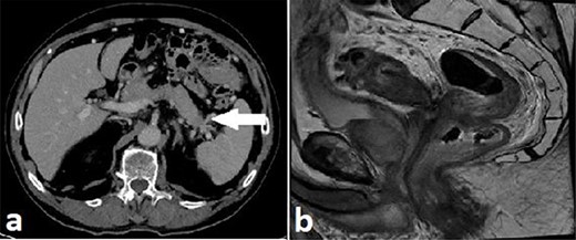 Case A. Axial portal venous phase CT scan demonstrating hypo-enhancing distal pancreatic lesion encasing splenic vessels (a) and sagittal MRI pelvis demonstrating anterior low rectal tumour (b), staged as a cT4aN2Mx rectal adenocarcinoma.