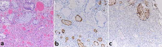 Case A. Specimen x10 magnification showing rectal metastasis from pancreatic ductal adenocarcinoma (a) with positive submucosal CK7+ immunostaining (b) and mucosal CK20+ immunostaining (c) but negative submucosal CK20 immunostaining(c).