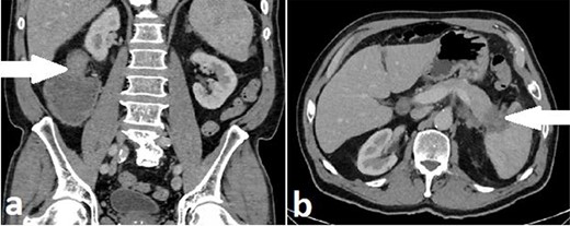 Case B. Portal venous phase CT scan of the abdomen. Coronal view of short segment hepatic flexure thickening (arrow) with proximal large bowel obstruction (a) and axial view of soft tissue mass (arrow) at tail of pancreas (b).
