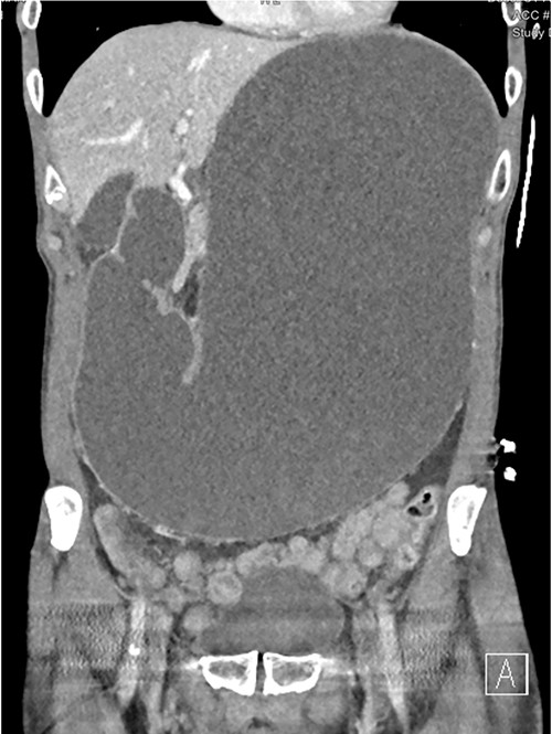 CT showing grossly distended stomach and duodenum.