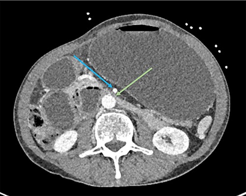 CT showing grossly distended stomach, first and second part of duodenum with sudden collapse and obstruction of duodenum (green arrow) at the superior mesenteric artery (blue arrow).