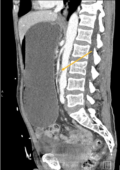 CT shows duodenum obstructed (orange arrow) between the aorta and superior mesenteric artery.