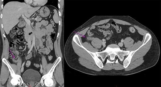 Abdominal CT scan showing a dilated and thickened appendix with periappendiceal fat stranding (arrow); coronal and axial view.