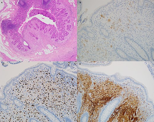 Histological sections of the ganglioneuroma. (A) hematoxylin and eosin, (B) Neu-N, (C) Sox10 and (D) S100.