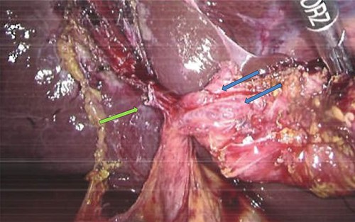 Intraoperative image showing gallbladder with two duct structures (blue arrows); cystic artery clipped on left (green arrow).