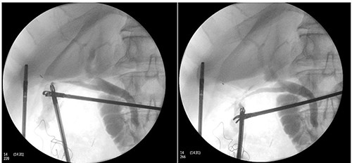 Intraoperative cholangiogram performed via one of two duct structures; double cystic duct not evident.