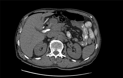 CT cholangiogram performed Day 1 post cholecystectomy confirming double cystic ducts.