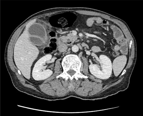 Axial section of preoperative CT abdomen from initial presentation showing thickened gallbladder with pericholecystic fluid; duplicated gallbladder evident, initially thought to be Phrygian cap sign.