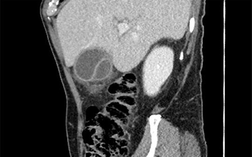 Sagittal view of duplicated gallbladder.