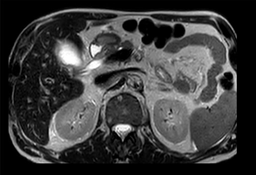 Preoperative T2-weighted MRCP; double cystic ducts seen upon retrospective review of images post cholecystectomy.