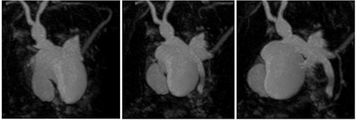 3D reconstruction of duplicated gallbladder and biliary tree from MRCP.