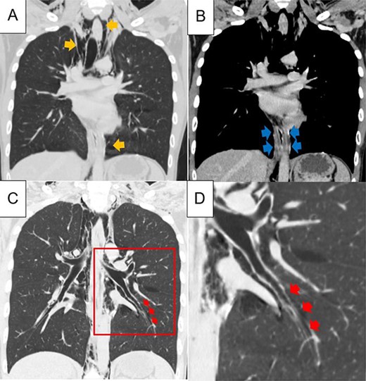Chest computed tomography showing extensive pneumomediastinum (A; yellow arrows); the lower oesophagus is swollen and thickened, but no large wall defects or perforations and fluid collection are observed (B, blue arrows); in the left lower lobe of the lung, accumulation of free air, a finding of the Macklin effect, is found along the peripheral bronchi or pulmonary vascular sheath, which is continuous with the mediastinum (C, D; red arrows); figure D shows a magnified view of the red squares in Figure C.