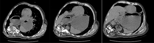 Axial slices of CT scan showing a moderate hiatus hernia with concern for obstruction and strangulation, with severe kyphoscoliosis.
