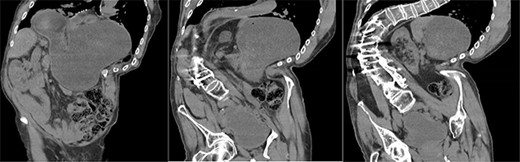 Coronal slices of CT scan showing a moderate hiatus hernia with concern for obstruction and strangulation, with severe kyphoscoliosis.