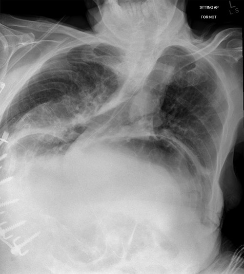 Chest X-ray showing nasogastric decompression of hiatus hernia, along with severe kyphoscoliosis.