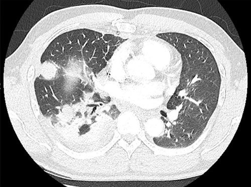 Computed tomography prior to extrapleural pneumonectomy.