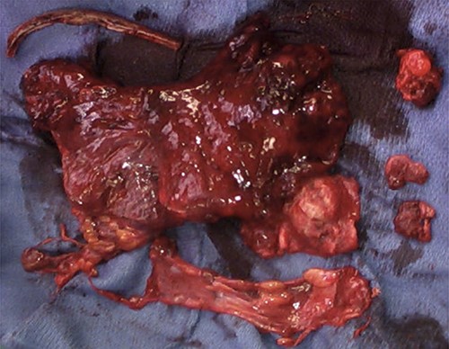 Extrapleural pneumonectomy specimen.